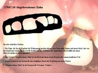 Broken tooth 17047.10