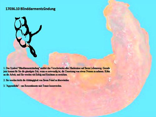 blindedarmontsteking 17036.10