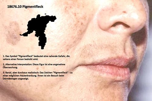 Pigmentvlek 18676.10