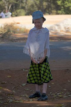 Albino girl in Zambia by Anjo Schuite