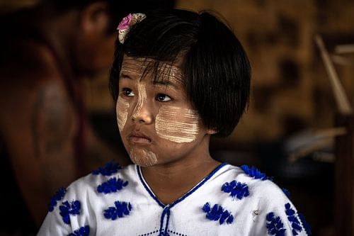 Girl with natural sunburn in Myanmar