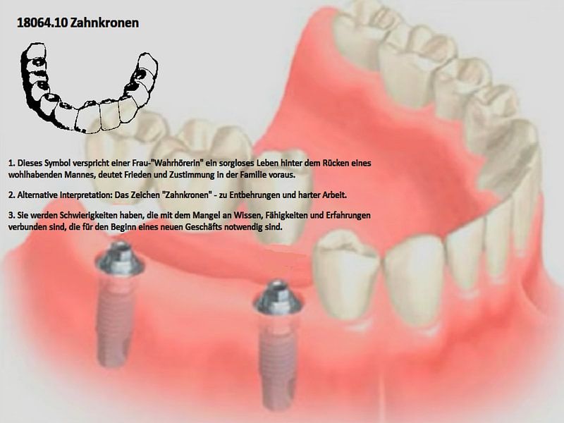 tandheelkundige kronen 18064,10 van Vladimir Zykunov